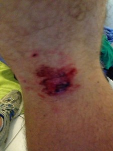The underside of Nigel Percival's knee after being bitten by an unleashed dog. PHOTO: Supplied